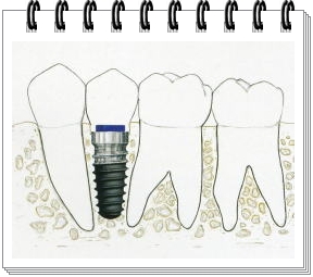 �C���v�����g�����C���[�W